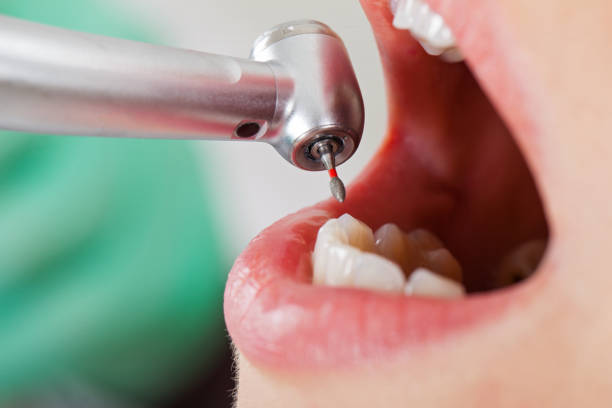 Best Knocked-Out Tooth (Avulsed Tooth) Treatment in Ashtabula, OH
